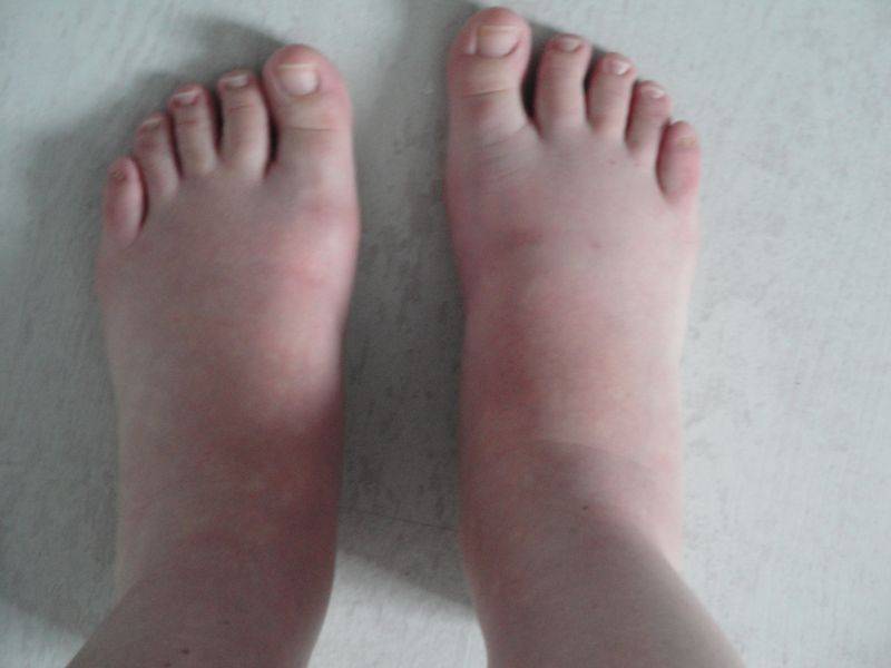 Pieds qui enflent: doit-on s’alarmer?